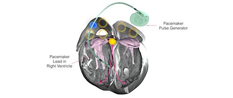 av junction box|av junction ablation.